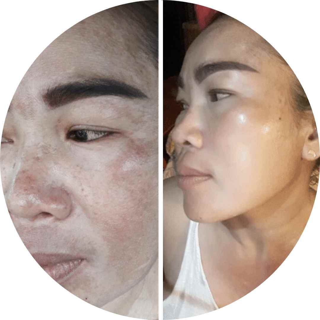 Acné, cosmetico, Thanaka cosmético, melasma, dermis, rosacea