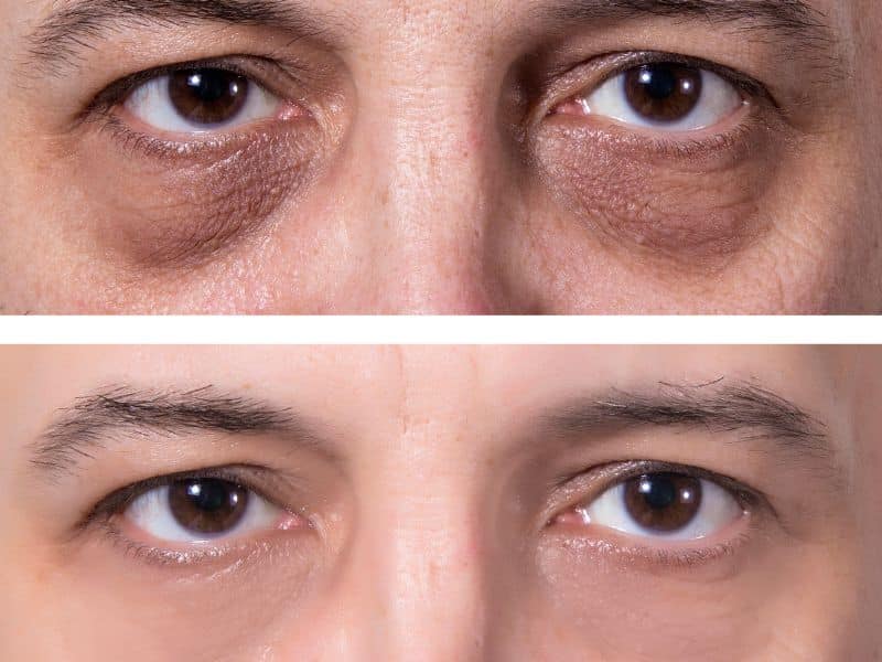 antes y despues contorno de ojos